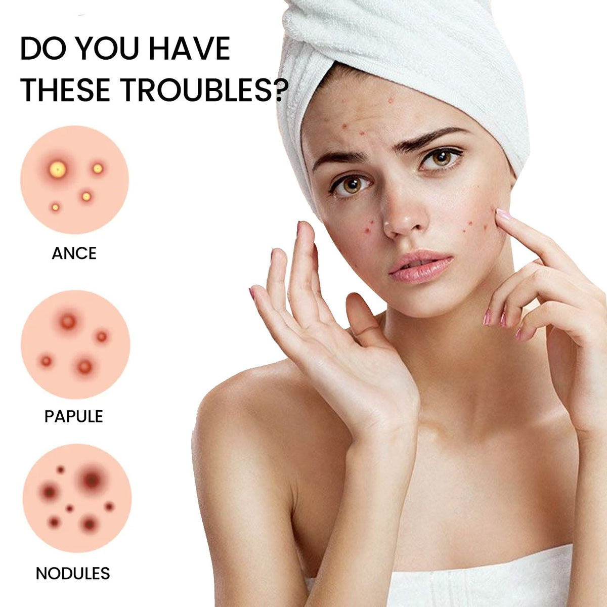 200 Hydrocolloid Acne Patches