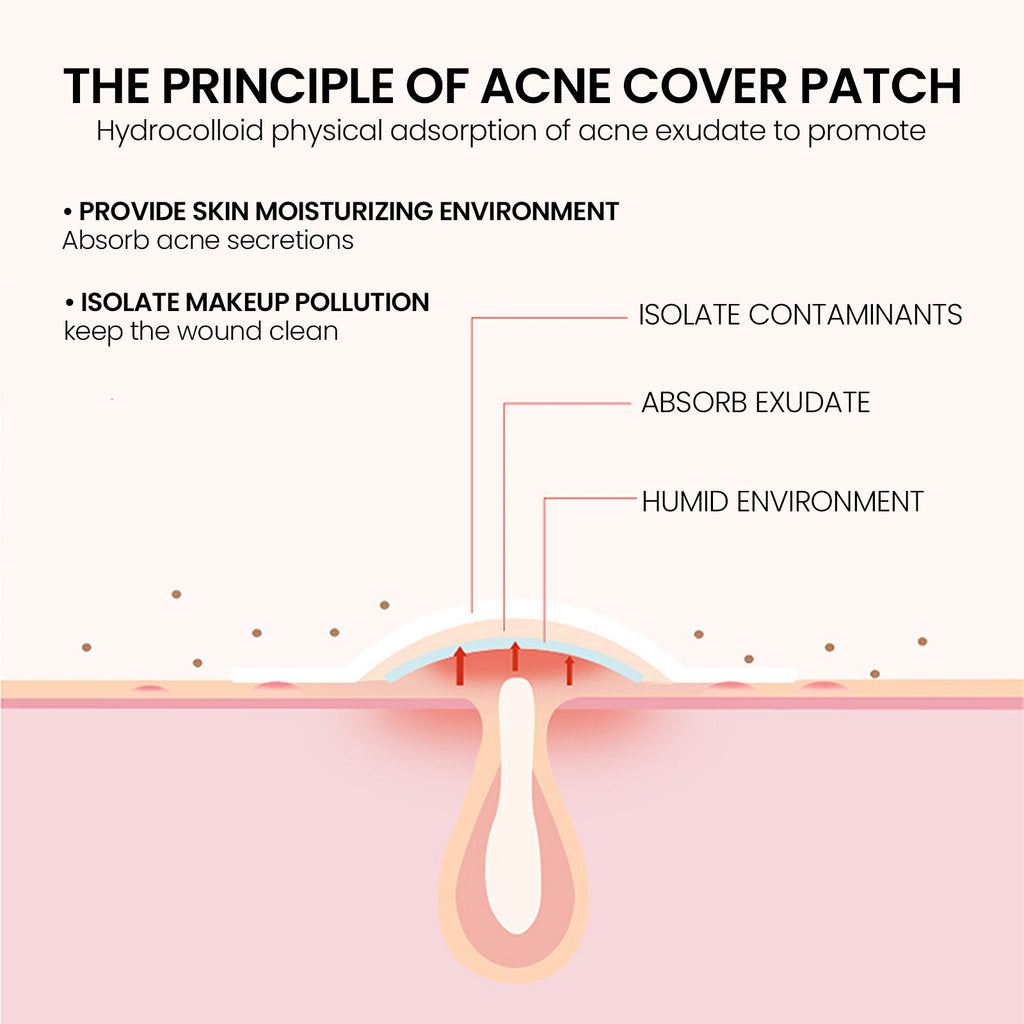 200 Hydrocolloid Acne Patches